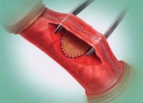 Surgical way of increasing a member