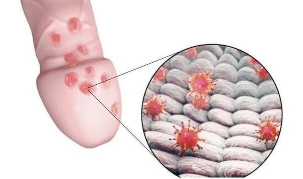 Allergy to penis enlargement gel