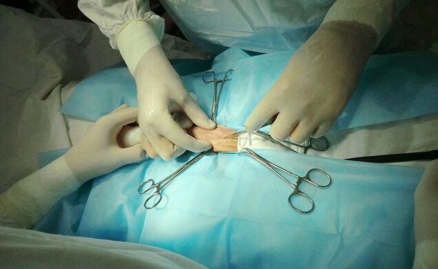 Surgery on the reproductive organ can help increase its size