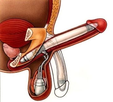 Flexion of the penis for enlargement